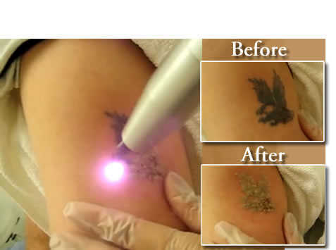 tattoo-removal-before-after1
